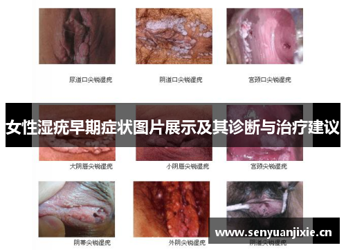 女性湿疣早期症状图片展示及其诊断与治疗建议