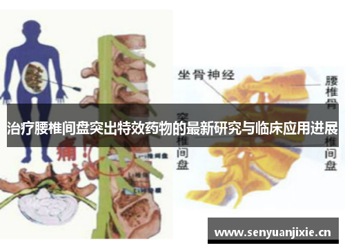 治疗腰椎间盘突出特效药物的最新研究与临床应用进展